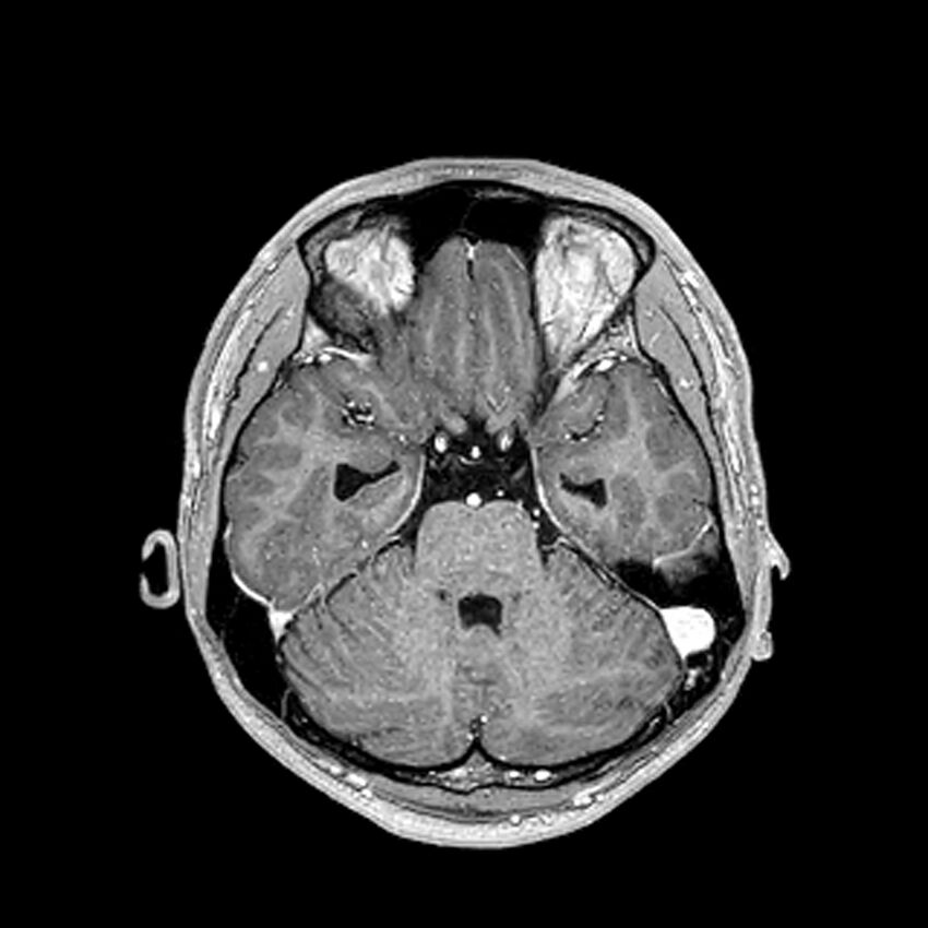 Central neurocytoma (Radiopaedia 79320-92380 Axial T1 C+ 90).jpg
