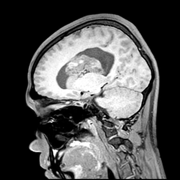File:Central neurocytoma (Radiopaedia 79320-92380 Sagittal T1 156).jpg