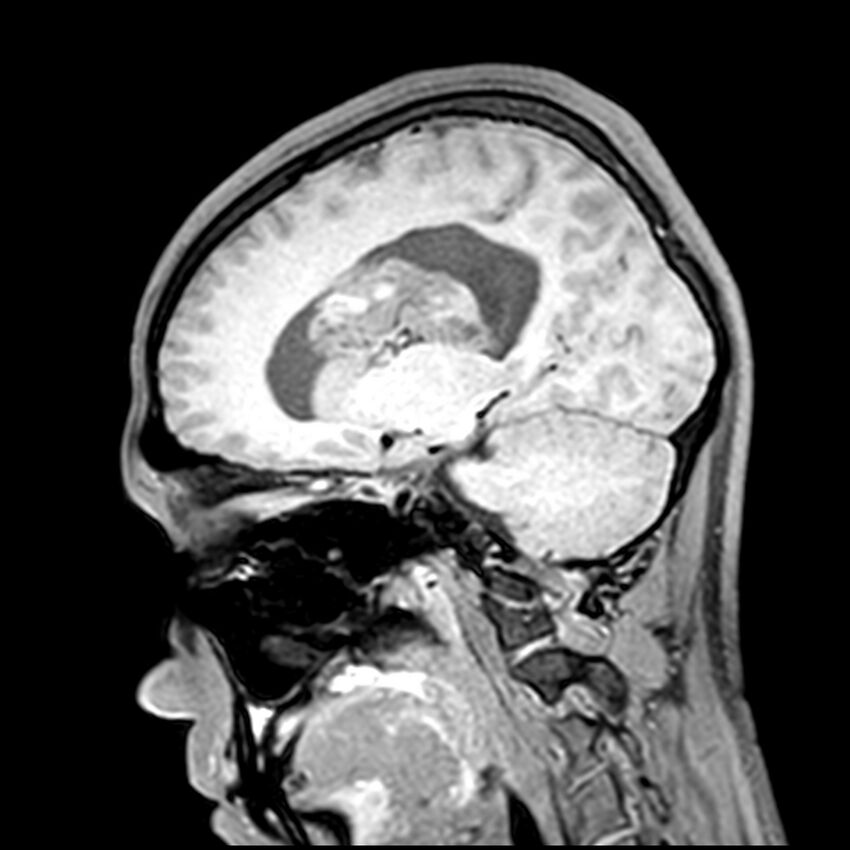 Central neurocytoma (Radiopaedia 79320-92380 Sagittal T1 156).jpg
