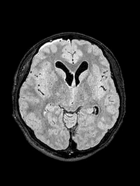 File:Central neurocytoma (Radiopaedia 79320-92381 Axial FLAIR 95).jpg