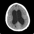 Cerebellar abscess secondary to mastoiditis (Radiopaedia 26284-26412 Axial non-contrast 101).jpg