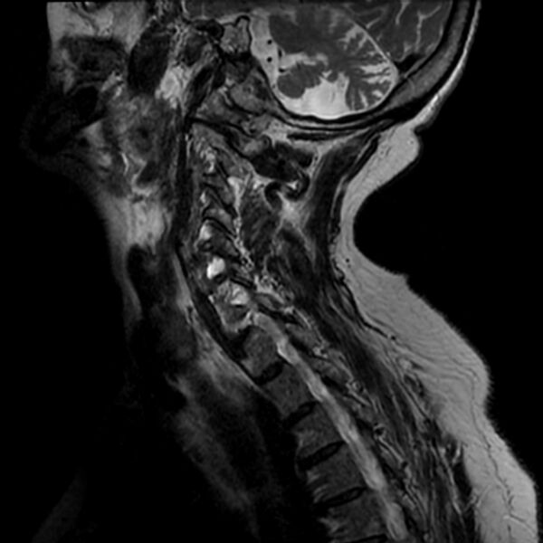 File:Cerebellar ataxia with neuropathy and vestibular areflexia syndrome (CANVAS) (Radiopaedia 74283-85159 Sagittal T2 2).jpg