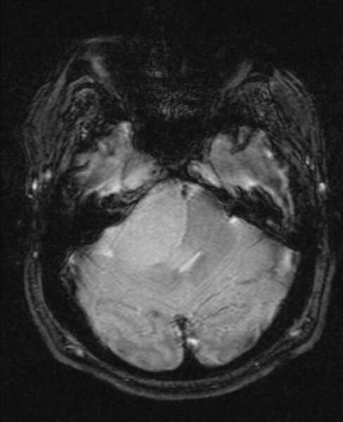 File:Cerebellopontine angle meningioma (Radiopaedia 24459-24764 Axial Gradient Echo 6).jpg