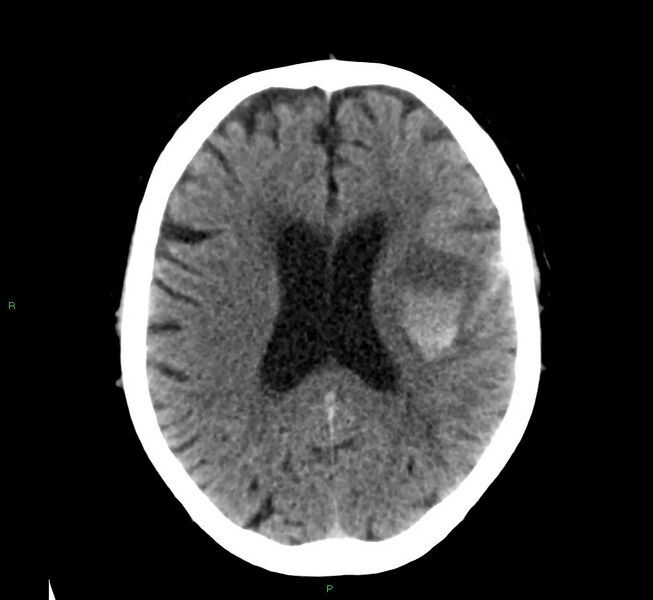 File:Cerebral amyloid angiopathy-associated lobar intracerebral hemorrhage (Radiopaedia 58376-65511 Axial non-contrast 24).jpg