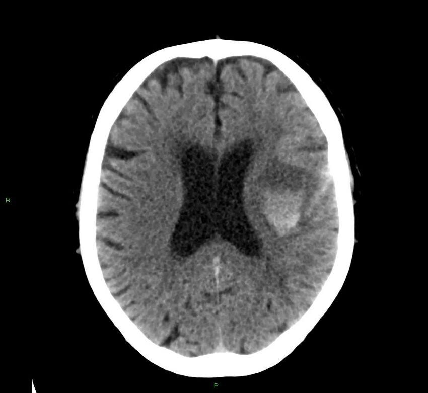 Cerebral amyloid angiopathy-associated lobar intracerebral hemorrhage (Radiopaedia 58376-65511 Axial non-contrast 24).jpg