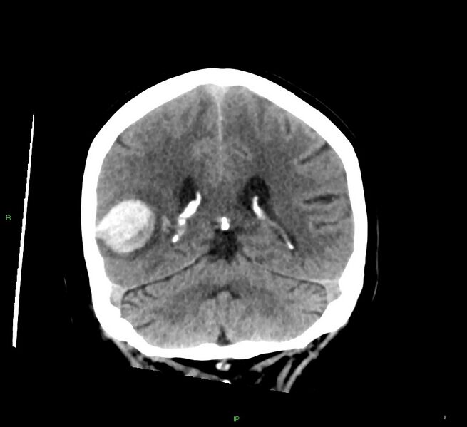 File:Cerebral amyloid angiopathy-associated lobar intracerebral hemorrhage (Radiopaedia 58378-65516 Coronal non-contrast 23).jpg