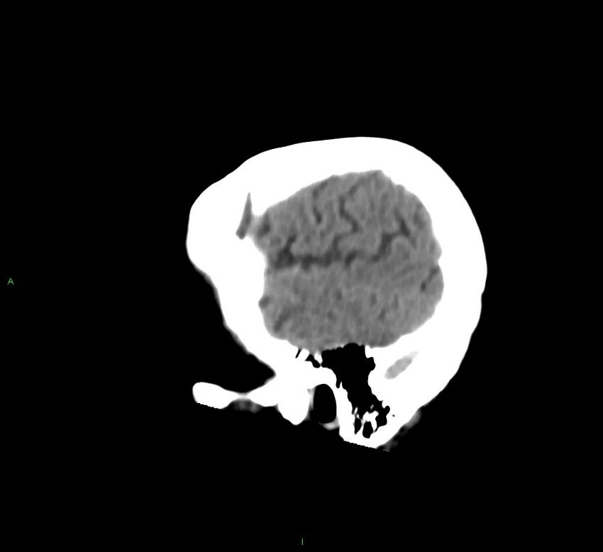 Cerebral amyloid angiopathy-associated lobar intracerebral hemorrhage (Radiopaedia 58530-65688 C 47).jpg