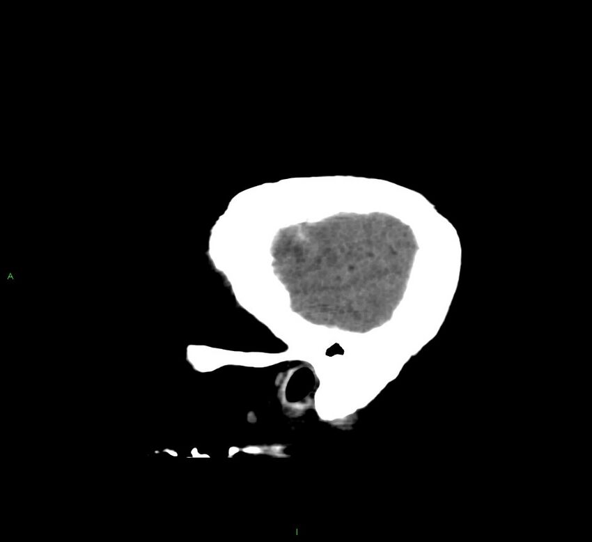 Cerebral amyloid angiopathy-associated lobar intracerebral hemorrhage (Radiopaedia 58560-65723 C 6).jpg