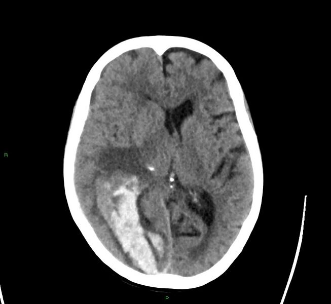 File:Cerebral amyloid angiopathy-associated lobar intracerebral hemorrhage (Radiopaedia 58563-65727 Axial non-contrast 28).jpg