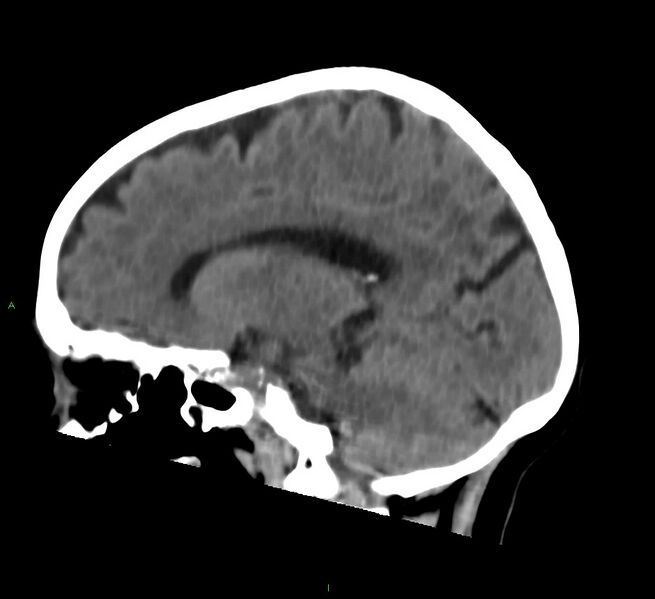 File:Cerebral amyloid angiopathy-associated lobar intracerebral hemorrhage (Radiopaedia 58757-65978 C 32).jpg