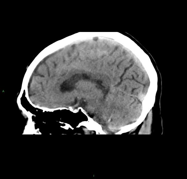 File:Cerebral amyloid angiopathy-associated lobar intracerebral hemorrhage (Radiopaedia 59356-66716 C 31).jpg