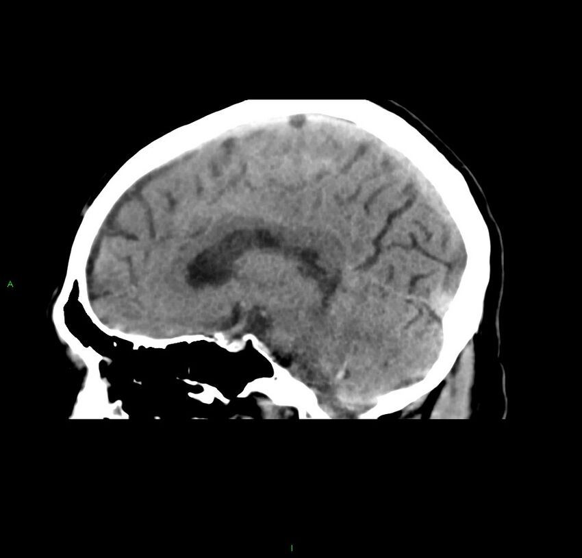 Cerebral amyloid angiopathy-associated lobar intracerebral hemorrhage (Radiopaedia 59356-66716 C 31).jpg