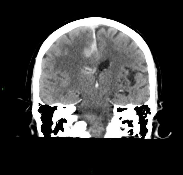 File:Cerebral amyloid angiopathy-associated lobar intracerebral hemorrhage (Radiopaedia 59356-66716 Coronal non-contrast 32).jpg