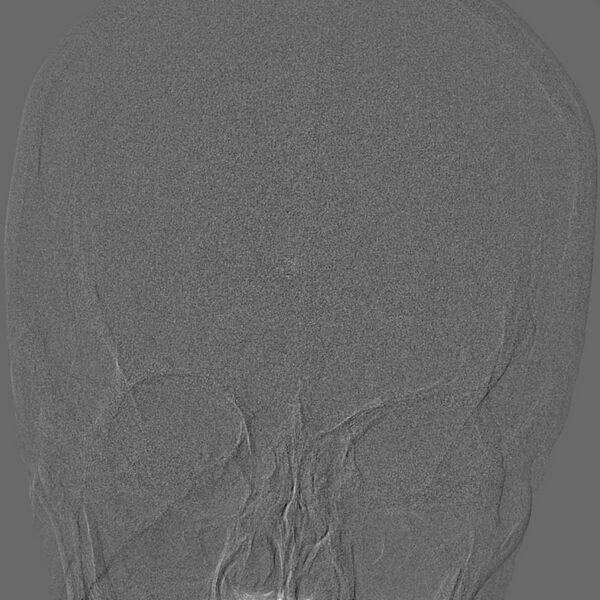 File:Cerebral aneurysm with rupture (Radiopaedia 29933-30458 LT ICA IC 7).jpg
