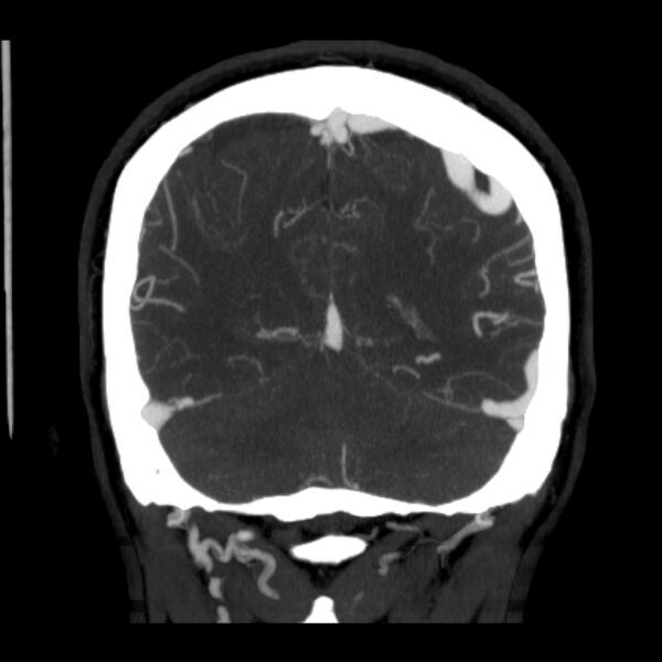File:Cerebral arteriovenous malformation (Radiopaedia 43729-47189 C 36).jpg