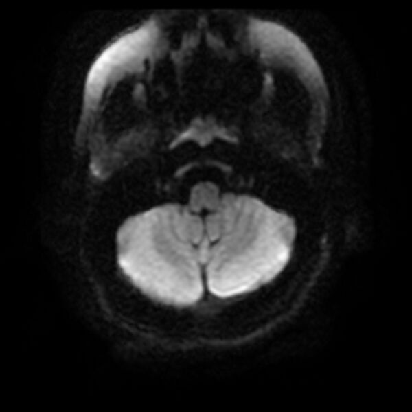File:Cerebral cavernous malformation (Radiopaedia 44301-47942 Axial DWI 4).jpg