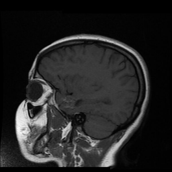 File:Cerebral cavernous malformation (Radiopaedia 44301-47942 Sagittal T1 5).jpg