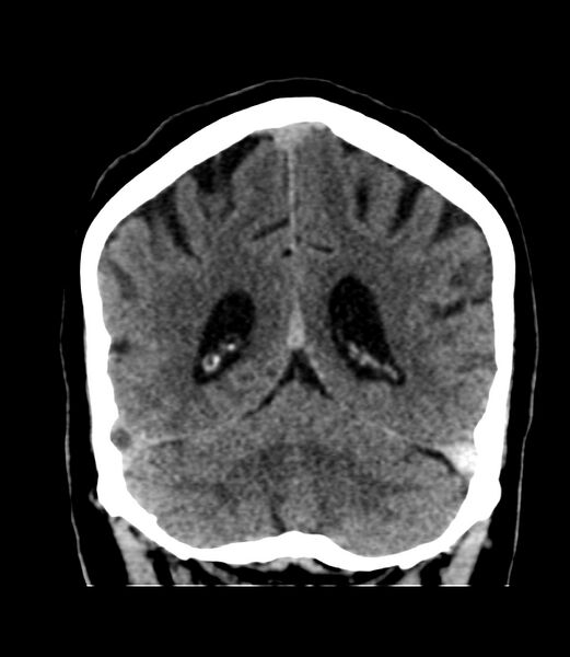 File:Cerebral dural venous sinus thrombosis (Radiopaedia 86514-102575 Coronal non-contrast 37).jpg