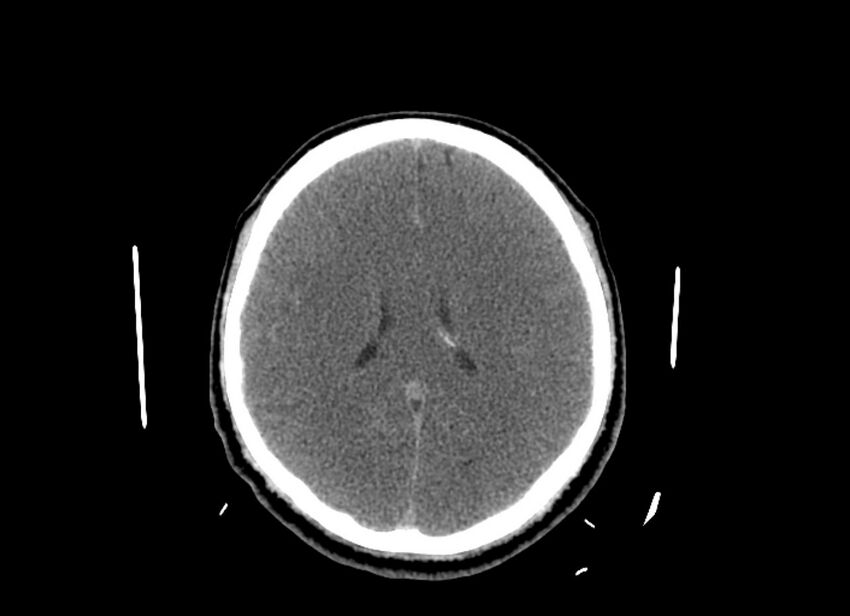 Cerebral edema (Radiopaedia 82519-96661 Axial non-contrast 22).jpg