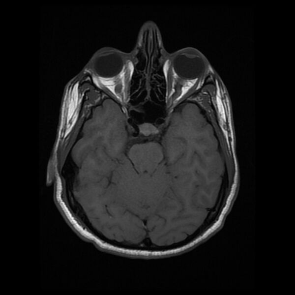 File:Cerebral fat embolism (Radiopaedia 37510-39363 Axial T1 10).jpg