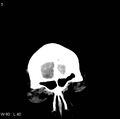Cerebral hemorrhagic contusion with subdural and subarachnoid hemorrhage (Radiopaedia 10680-11146 Coronal non-contrast 1).jpg