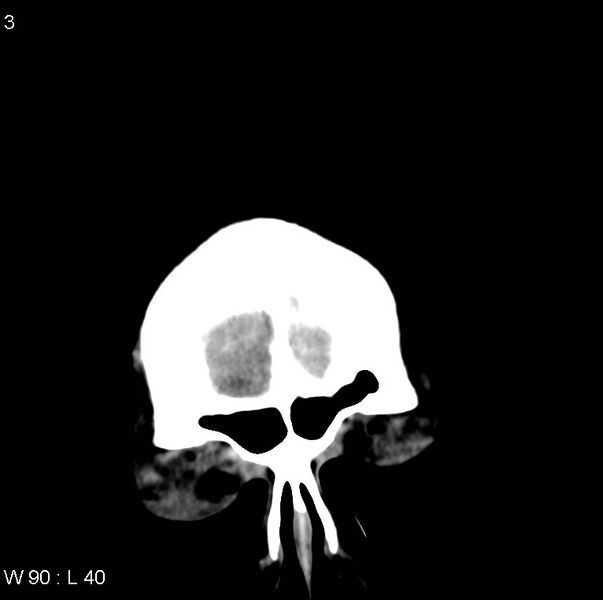 File:Cerebral hemorrhagic contusion with subdural and subarachnoid hemorrhage (Radiopaedia 10680-11146 Coronal non-contrast 1).jpg