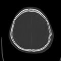 Cerebral hemorrhagic contusions (Radiopaedia 23145-23188 Axial bone window 44).jpg