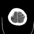 Cerebral hemorrhagic contusions (Radiopaedia 23145-23188 Axial non-contrast 37).jpg