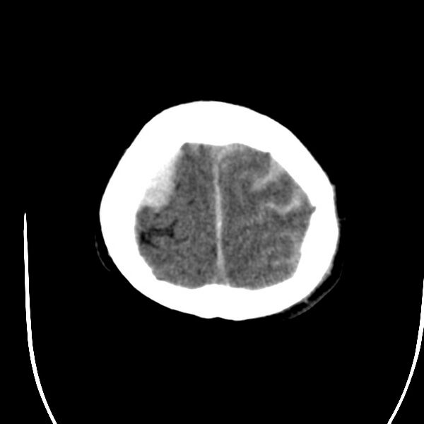File:Cerebral hemorrhagic contusions (Radiopaedia 23145-23188 Axial non-contrast 37).jpg