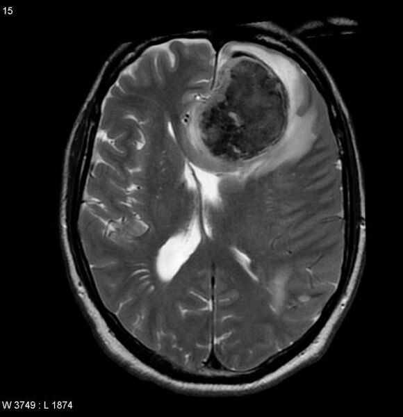 File:Cerebral metastases - renal cell carcinoma (Radiopaedia 5510-7246 Axial T2 3).jpg