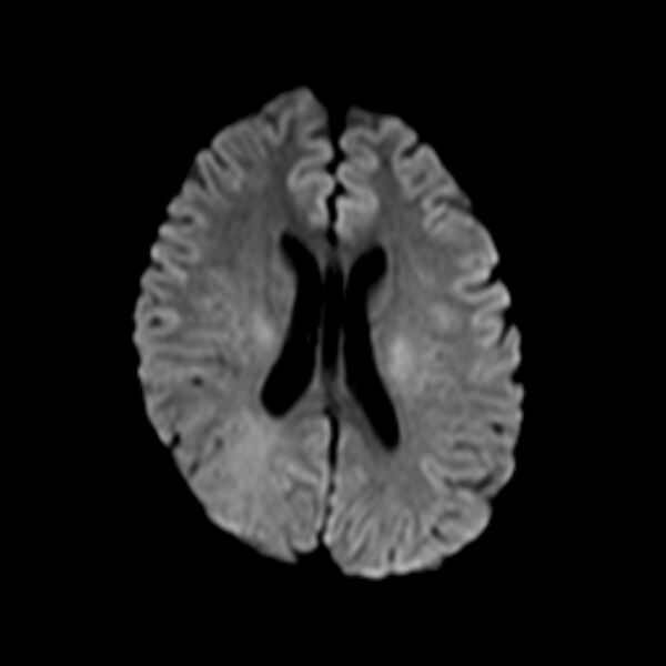 File:Cerebral tuberculoma (Radiopaedia 41152-43932 Axial DWI 14).jpg