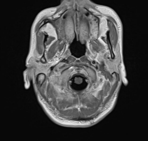 File:Cerebral venous thrombosis (Radiopaedia 71207-81504 Axial T1 C+ 2).jpg