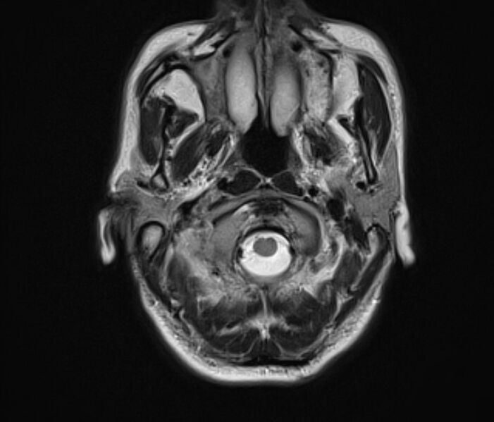 File:Cerebral venous thrombosis (Radiopaedia 71207-81504 Axial T2 3).jpg