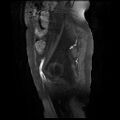Cervical carcinoma (Radiopaedia 78847-91705 I 16).jpg