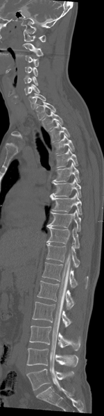 File:Cervical dural CSF leak on MRI and CT treated by blood patch (Radiopaedia 49748-54996 A 14).png