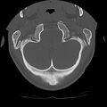 Cervical flexion teardrop fracture with cord hemorrhage (Radiopaedia 32497-33454 Axial bone window 10).jpg