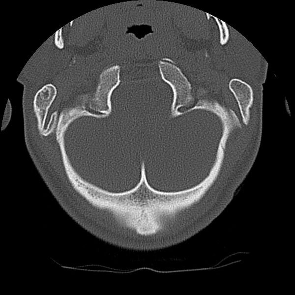 File:Cervical flexion teardrop fracture with cord hemorrhage (Radiopaedia 32497-33454 Axial bone window 10).jpg