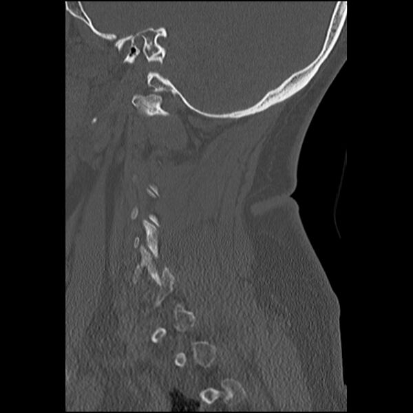 File:Cervical fracture and dislocation with locked facet (Radiopaedia 31837-32780 Sagittal bone window 30).jpg