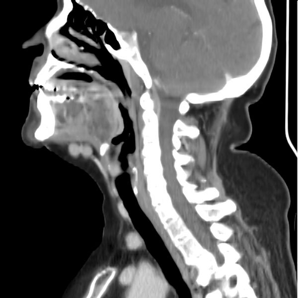 File:Cervical lymphadenopathy- cause unknown (Radiopaedia 22420-22457 D 21).jpg