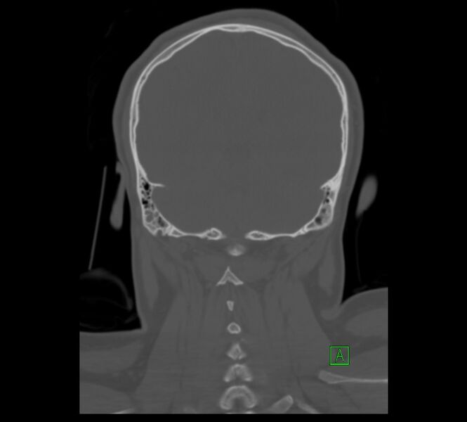 File:Cervical spine fracture - hyperflexion injury (Radiopaedia 66184-75364 Coronal bone window 14).jpg