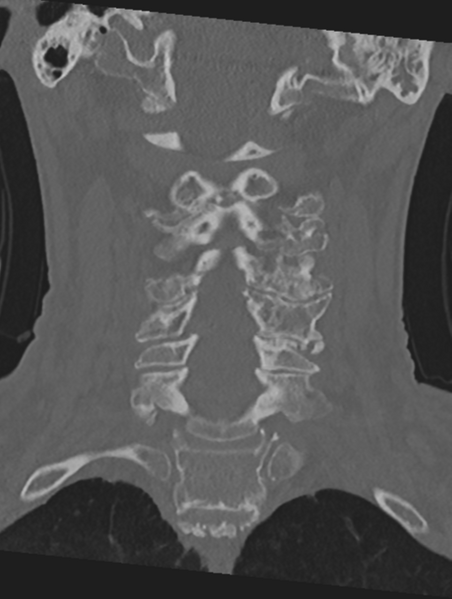 File:Cervical spondylolysis (Radiopaedia 49616-54811 Coronal bone window 27).png