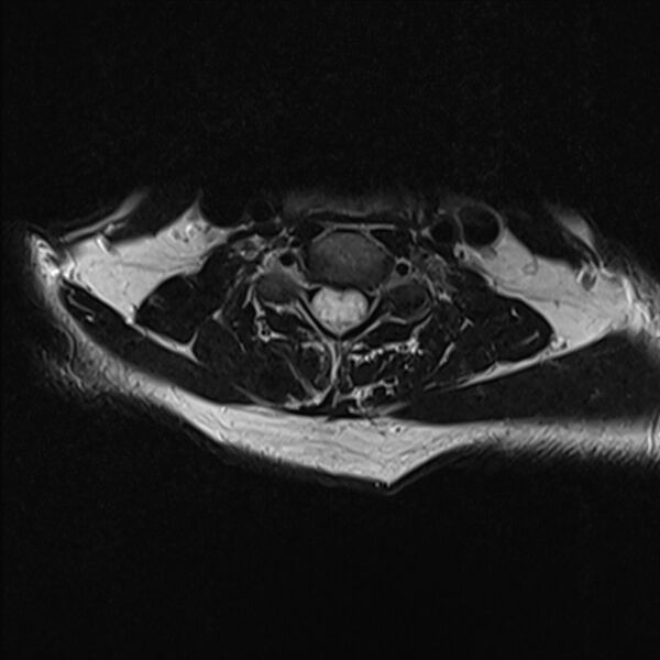 File:Cervical tumor-like myelopathy due to Type V dAVF (Radiopaedia 82461-96604 Axial T2 22).jpg