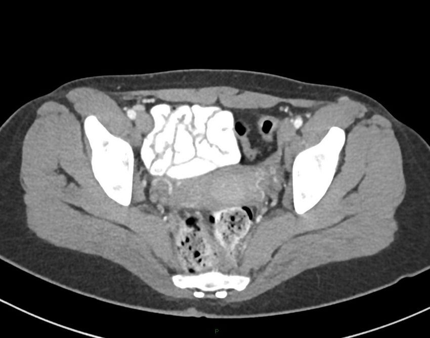 Cesarean scar endometriosis (Radiopaedia 82925-97262 A 76).jpg