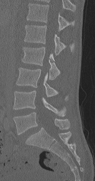 File:Chance fracture (Radiopaedia 40360-42912 Sagittal bone window 55).png