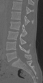 Chance fracture (Radiopaedia 40360-42912 Sagittal bone window 55).png