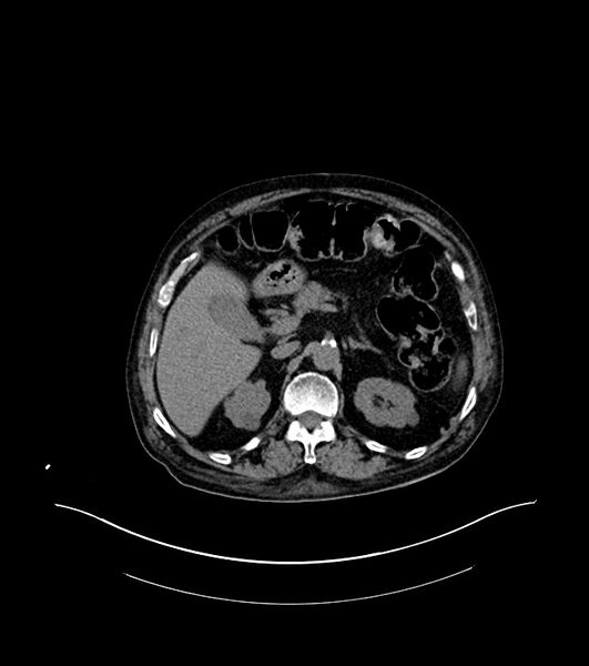 File:Cholangiocarcinoma with cerebral metastases (Radiopaedia 83519-98629 Axial non-contrast 31).jpg