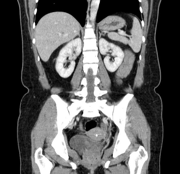 File:Choledocholithiasis on CT and MRI (Radiopaedia 24825-25087 C 33).jpg