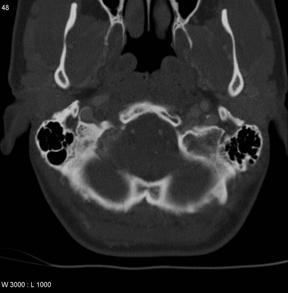 File:Chondroblastoma - occipital condyle (Radiopaedia 5569-7304 bone window 1).jpg
