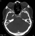 Chondrosarcoma - sphenoid wing (Radiopaedia 5421-7174 Axial bone window 2).jpg