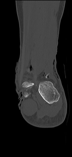 File:Chopart fracture (Radiopaedia 35347-36851 Coronal bone window 20).jpg